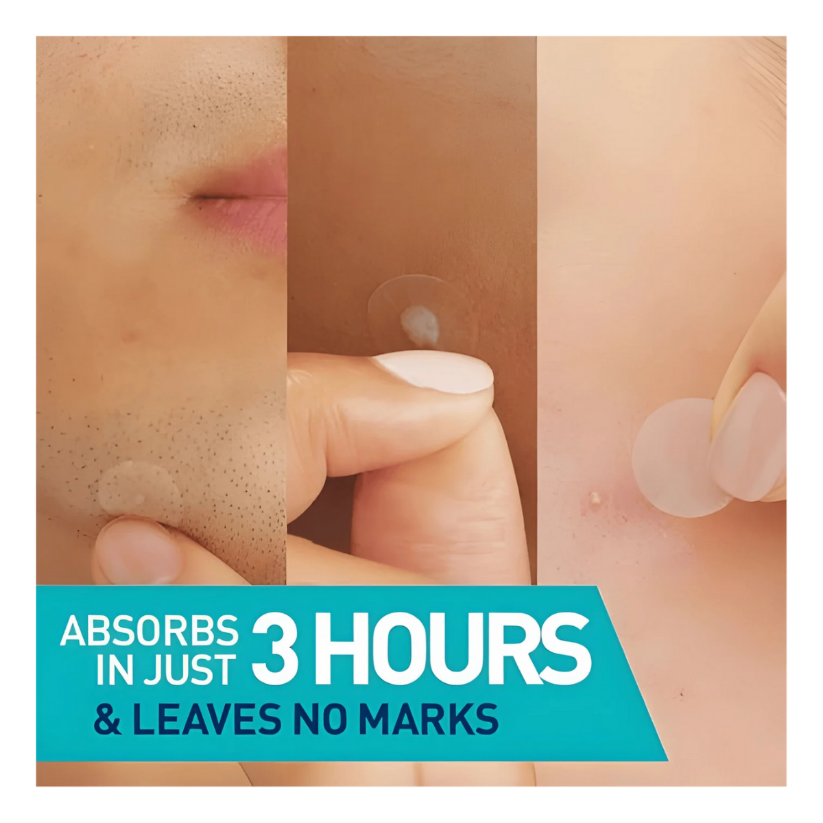 CeraVe Acne Control Patches - 22ct