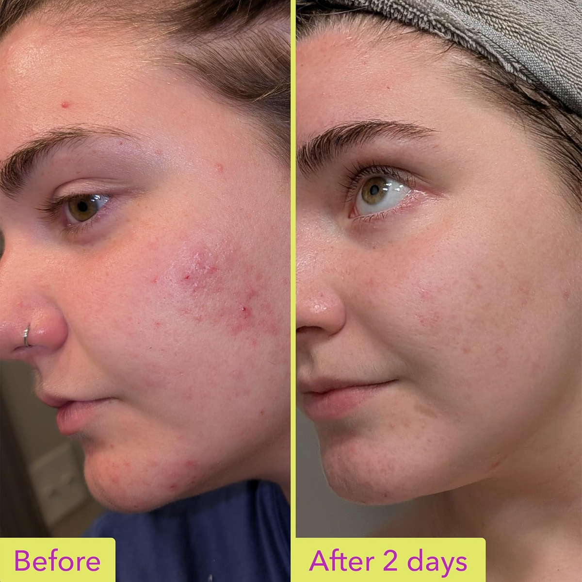 Good Molecules 10% Azelaic Acid Face Treatment - 30ml